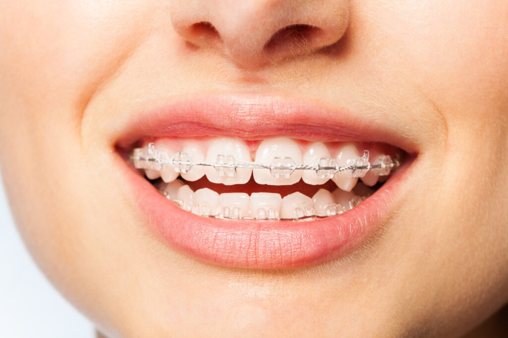 Clear ceramic braces with tooth-colored brackets blending with a patient's teeth