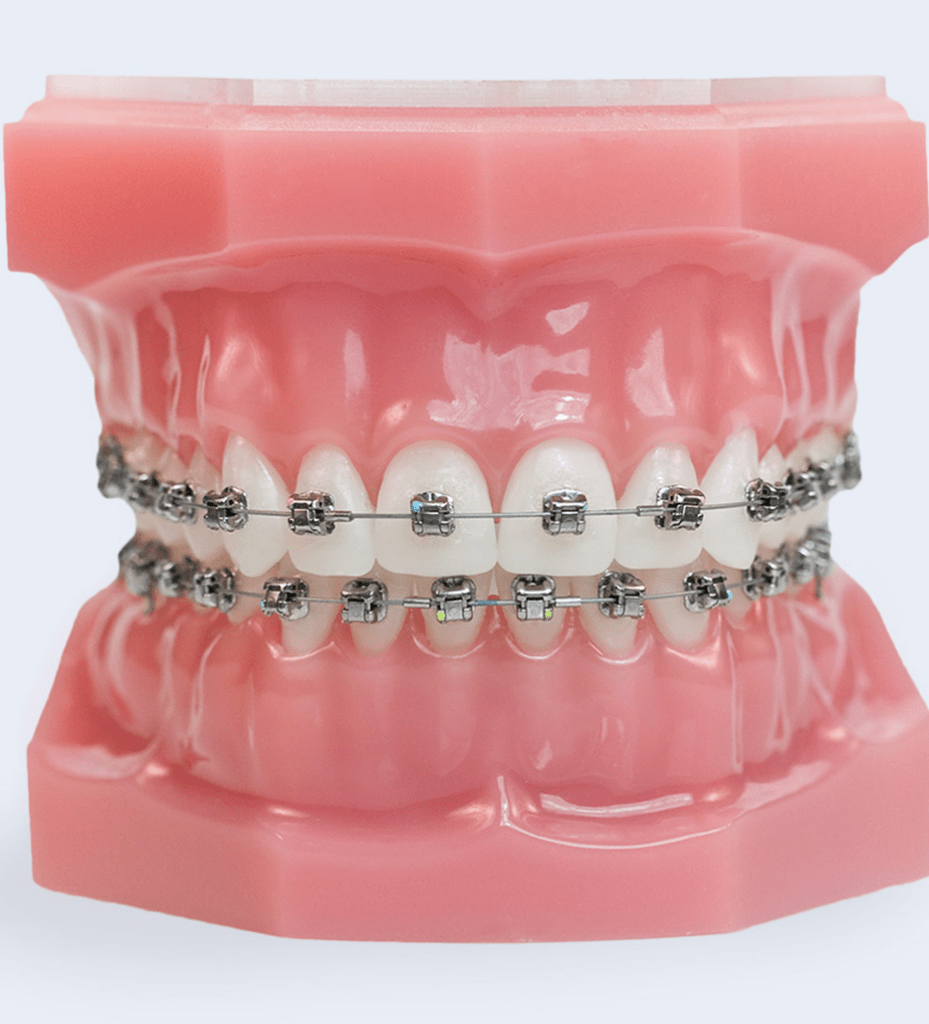 Side-by-side comparison of two orthodontic bracket systems used for braces